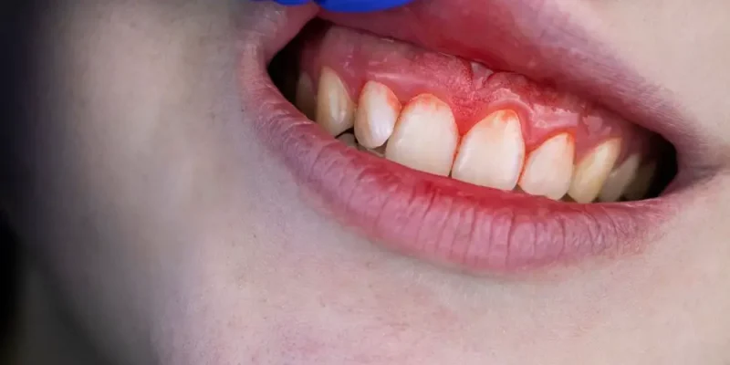 K05 Gingiviti dhe sëmundjet periodontale (Gingivitis et morbi periodontales)