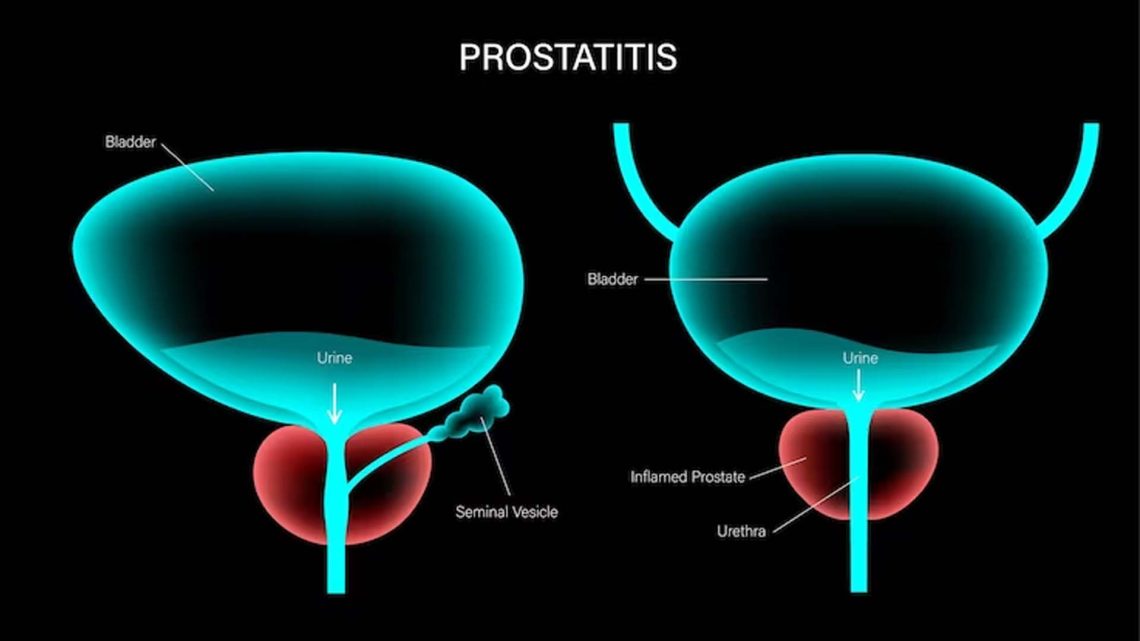 N41.0  Prostatiti akut (Prostatitis acuta)