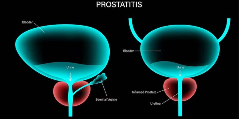 N41.0  Акутен простатит (Prostatitis acuta)